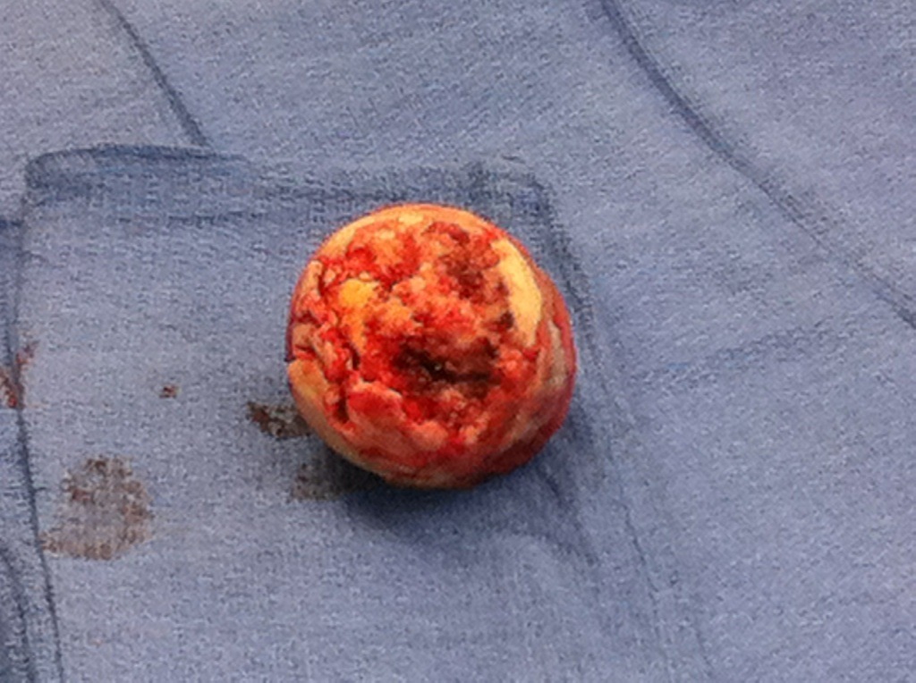 femoral