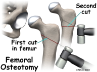 Femoral Osteotomy