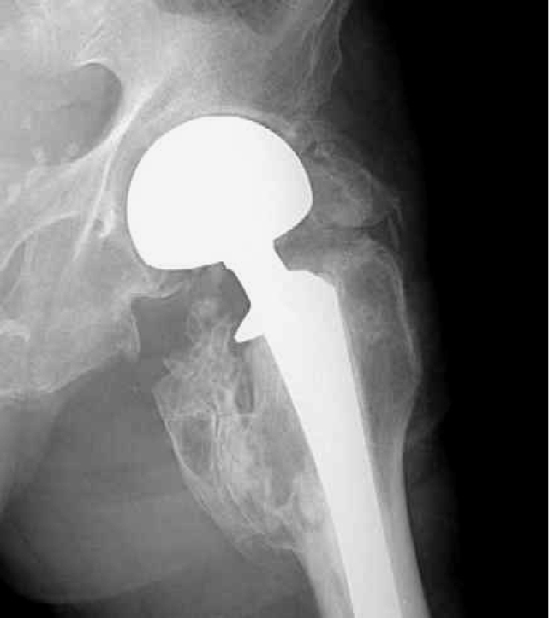 Heterotopic Ossification