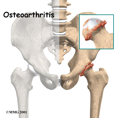 Osteoarthritis