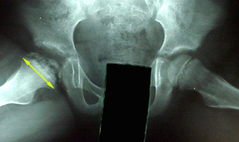 Perthes xray