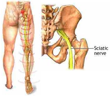 Sciatica