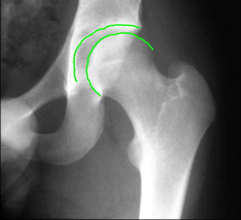 Patient X-Ray Images | Psoas Muscle Release | SurfaceHippy