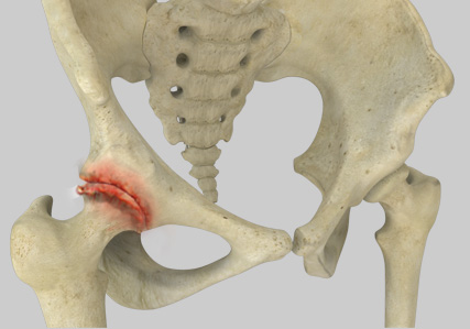 Osteoarthritis