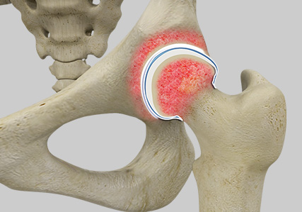 Rheumatoid Arthritis